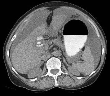Figure 17: patient of infiltrative carcinoma with ascites cholelithiasis and peritoneal enhancement.